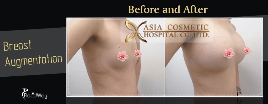 Before and After Pictures Breast Augmentation in Thailand